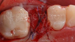 5 Geistlich Bio-Gide® è ritagliata per coprire l’innesto e fissata con una sutura a materassaio incrociato dopo essere stata inserita nel solco