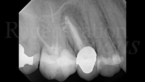 2 Radiografia intraorale iniziale che conferma la necessità di estrazione dell’elemento 15