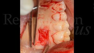 7 Prelievo di innesto epitelio-connettivale dalla mucosa palatina sinistra