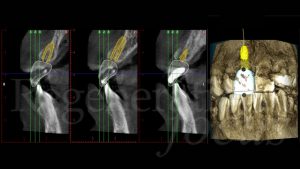 2 Sezioni tomografiche Cone Beam che simulano la corretta posizione impianto-corona - La parte più apicale dell’impianto si troverà esposta