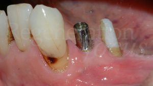 14 Perno implantare in titanio