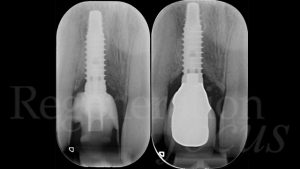 14 Immagini radiografiche al momento del carico protesico (sinistra) e dopo 2.5 anni