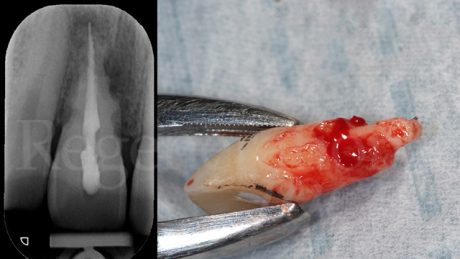 2 RX iniziale e foto dente estratto. E’ stata evidenziata la CEJ per il riposizionamento del dente pontic