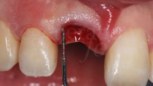 3 Verifica dell’integrità delle pareti alveolari