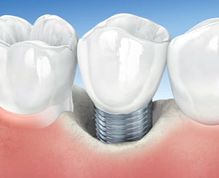 Peri implantite Geistlich RF - Regeneration Focus - Geistlich