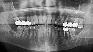 1 Ortopanoramica di inizio cure: parodontite cronica, ascessi parodontali su 2.5, 2.8, 3.6 e 3.7