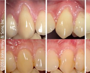 copertura radicolare Geistlich Mucograft