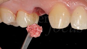 8 Posizionamento del biomateriale osseo di derivazione bovina a lento riassorbimento