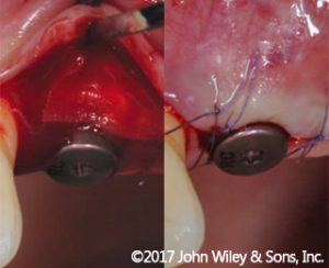 Geistlich_Mucograft_perimplantare-Cairo2017