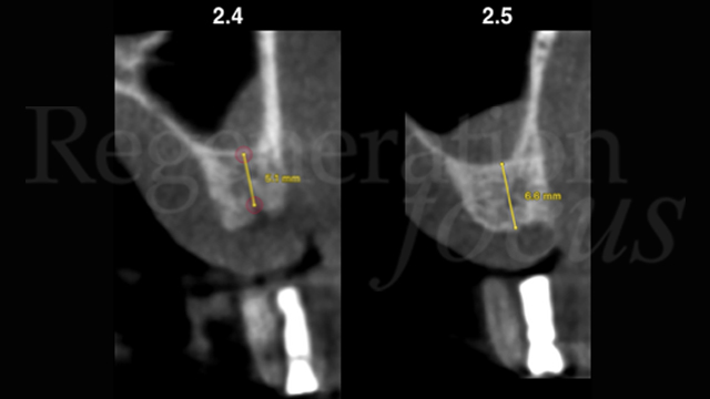 1 Sezione TC che mostra una distanza tra la  sommità della cresta ossea  e il pavimento del seno mascellare insufficiente al posizionamento degli impianti in posizione 24 e 25