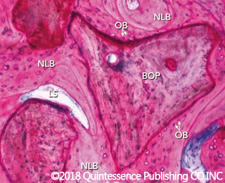 Antoun2018 GBO sinus - Regeneration Focus - Geistlich