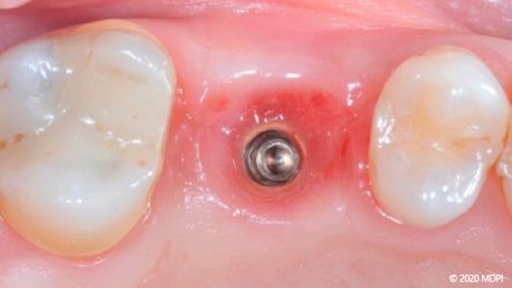 800x450 RF Aumento dei tessuti molli perimplantari tramite matrice in collagene 1