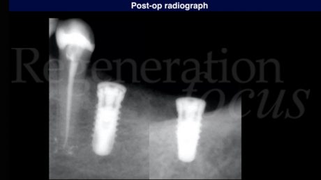 11 Radiografia post-operatoria