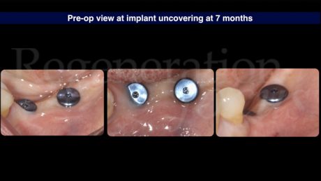 12 Vista pre-operatoria. La scopertura implantare è stata effettuata 7 mesi dopo il posizionamento implantare