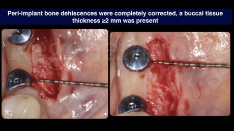 13 La deiscenza ossea peri-implantare è stata corretta. Presenza di tessuto vestibolare dello spessore ≥ 2 mm