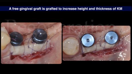 14 Per aumentare l’altezza e lo spessore della mucosa cheratinizzata peri-implantare, è stato posizionato un innesto gengivale libero prelevato dal palato