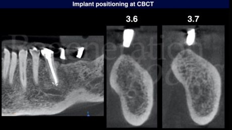 1 CBCT con mascherina radiologica per la programmazione protesicamente guidata del posizionamento implantare