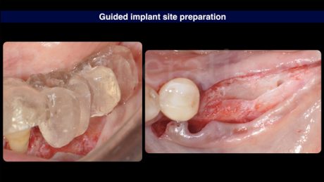 5 Preparazione del sito implantare