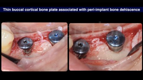 6 Cresta ossea sottile associata a deiscenza ossea peri-implantare