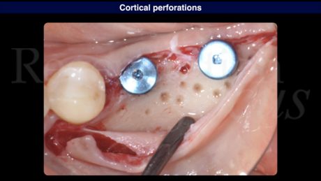 7 Perforazioni della corticale ossea