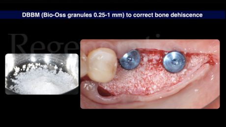 8 Lo spazio tra strato periostale e le superfici implantari esposte è stato riempito con Geistlich Bio-Oss® per correggere le deiscenze e al contempo incrementare lo spessore osseo vestibolare sulla porzione più coronale degli impianti