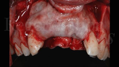 L’innesto è stato coperto con una membrana riassorbibile in collagene Geistlich Bio-Gide®.