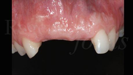 Immagine clinica della guarigione dopo 6 mesi che evidenzia l’incremento di volume della cresta edentula.