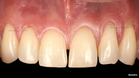 Una paziente di 35 anni si presenta con recessioni multiple nel settore superiore, riportando sensibilità dentinale e insoddisfazione estetica per gli elementi 22 e 23.