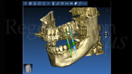 È stata effettuata la progettazione implantare guidata utilizzando il software RealGuide™