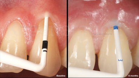Paragone tra la situazione al baseline e dopo 6 mesi in termine di fenotipo gengivale mediante uso di color-coded probes (Hu-Friedy, USA). E’ possibile apprezzare il canino presentava un fenotipo parodontale sottile al baseline, mentre il fenotipo dopo 6 mesi è spesso