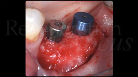 A 6 mesi dal posizionamento implantare gli impianti sono stati esposti chirurgicamente per inserire le viti di guarigione e aumentare contestualmente il fenotipo dei tessuti molli peri-implantari