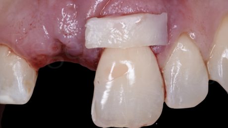 Per ricoprire la recessione sul dente naturale 2.1, dopo attenta levigatura della radice e condizionamento con EDTA, si è proceduto con un prelievo palatale tramite incisione rettangolare epitelio connettivale di spessore di 1,5 mm, altezza di circa 4 mm e lunghezza pari alla zona da trattare, circa 10 mm