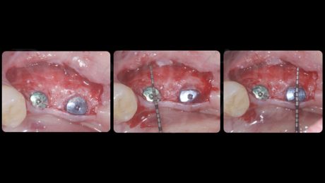 Sollevamento del lembo a spessore parziale vestibolare. Le deiscenze sono state completamente corrette ed era presente uno spessore di tessuto duro vestibolare di 3 mm su entrambi gli impianti.