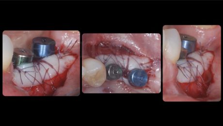 È stato prelevato un innesto epitelio-connettivale dal palato, per aumentare altezza e spessore del fenotipo dei tessuti molli peri-implantari, ed è stato suturato vestibolarmente stabilizzandolo al letto ricevente e alla gengiva linguale tramite punti singoli e suture compressive a materassaio esterno