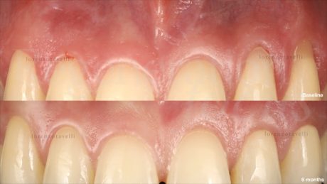 Baseline vs 6 mesi (vista frontale)