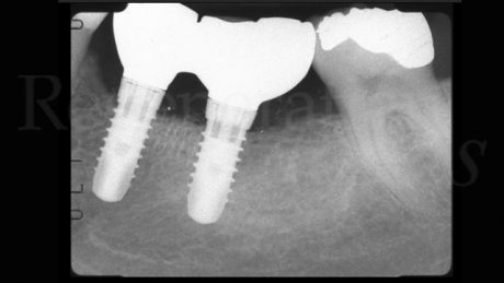 Radiografia che mostra il livello osseo ottimale