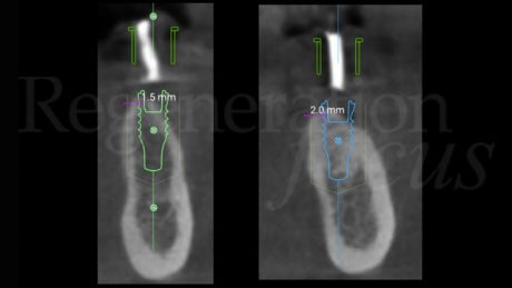 La progettazione implantare guidata ha permesso di diagnosticare una deiscenza vestibolare di 3 mm sull’impianto in posizione 3.5 e di 2 mm su 3.6, al termine del posizionamento