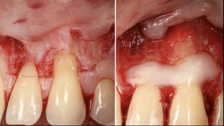 É stato eseguito un lembo avanzato coronale trapezoidale, con elevazione del tessuto interprossimale a mezzo spessore ed elevazione a tutto spessore a livello delle radici. Dopo aver esposto 2-3 mm della cresta ossea, l’elevazione del lembo è stata continuata a mezzo spessore. Dopo aver strumentato meccanicamente le radici, è stato applicato EDTA al 24% per 2 minuti, seguito da un lavaggio con soluzione fisiologica.