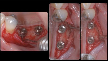 Posizionamento di due impianti cilindrici tissue level (Element SPI, Thommen Medical)