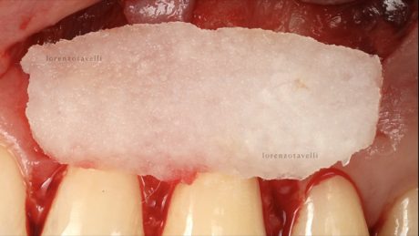 La matrice in collagene bagnata con soluzione fisiologica e posizionata sul sito ricevente