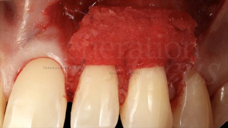 Stabilizzazione della matrice in collagene con suture semplici (7/0 PGA) al periostio (apicalmente) e alle papille disepitelizzate (coronalmente)