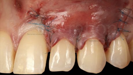 Il lembo è stato avanzato coronalmente e stabilizzato con suture sospese a livello delle papille chirurgiche, mentre diverse suture semplici sono state eseguite a livello degli scarichi verticali (7/0 polypropylene)