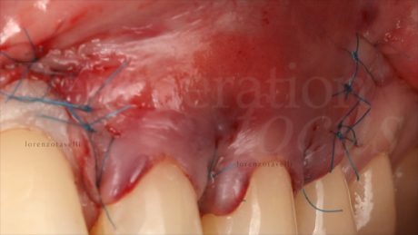 Il lembo è stato avanzato coronalmente e stabilizzato con suture sospese a livello delle papille chirurgiche, mentre diverse suture semplici sono state eseguite a livello degli scarichi verticali (7/0 polypropylene)