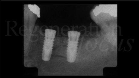 Radiografia post-operatoria