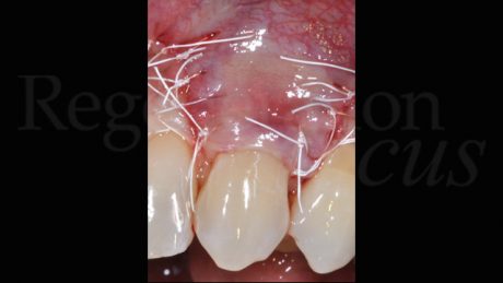 4. Immagine post-operatoria del lembo suturato in una posizione più coronale rispetto al presunto livello di ricopertura radicolare finale