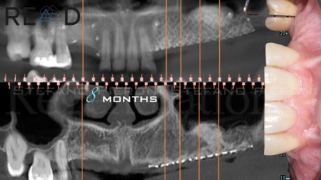 15. Immagine CBCT che mostra la formazione del contorno osseo dopo 8 mesi