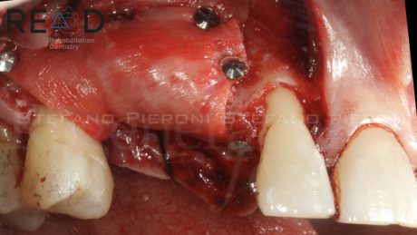 9. GBR con una membrana riassorbibile in collagene (Geistlich Bio-Gide®) e un mix di osso autologo e Geistlich Bio-Oss®. La membrana è stata fissata con dei pin