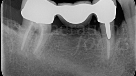 Radiografia pre-operatoria: difetto infraosseo mesiale al dente 44.