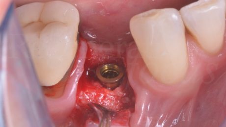 Data l’alta stabilità primaria (maggiore di 40 N/cm2) si opta per fissare un abutment intermedio al momento dell’inserimento implantare.