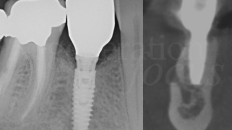 Al controllo Rx a 12 mesi si nota la stabilità dei tessuti duri sia con l’esame 2D, che evidenzia i picchi ossei interprossimali, sia a livello 3D, dove si apprezza lo spessore vestibolare della cresta.